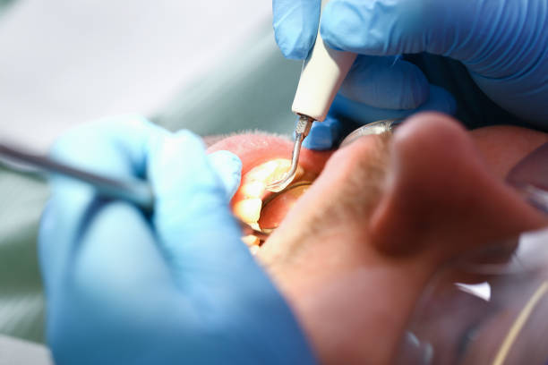 Best Emergency Dental Extractions in West Columbia, TX